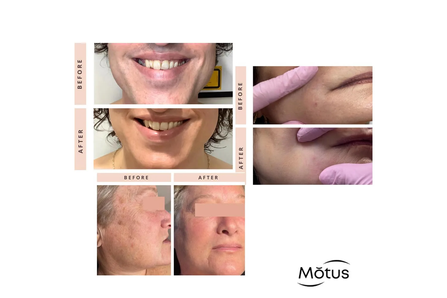 motus