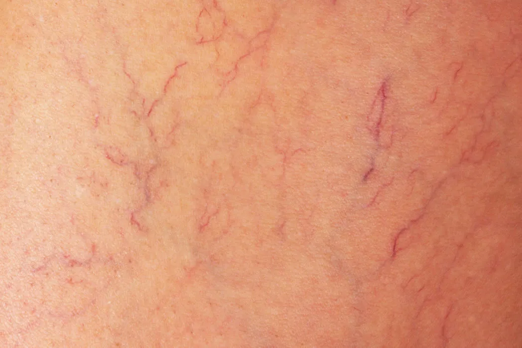 beautiful-woman-perlane-dermatology