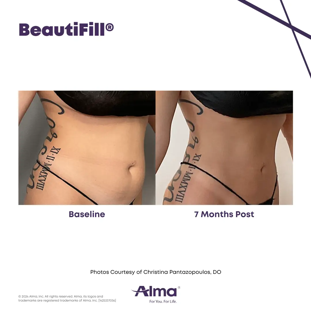 BeautiFill_BA