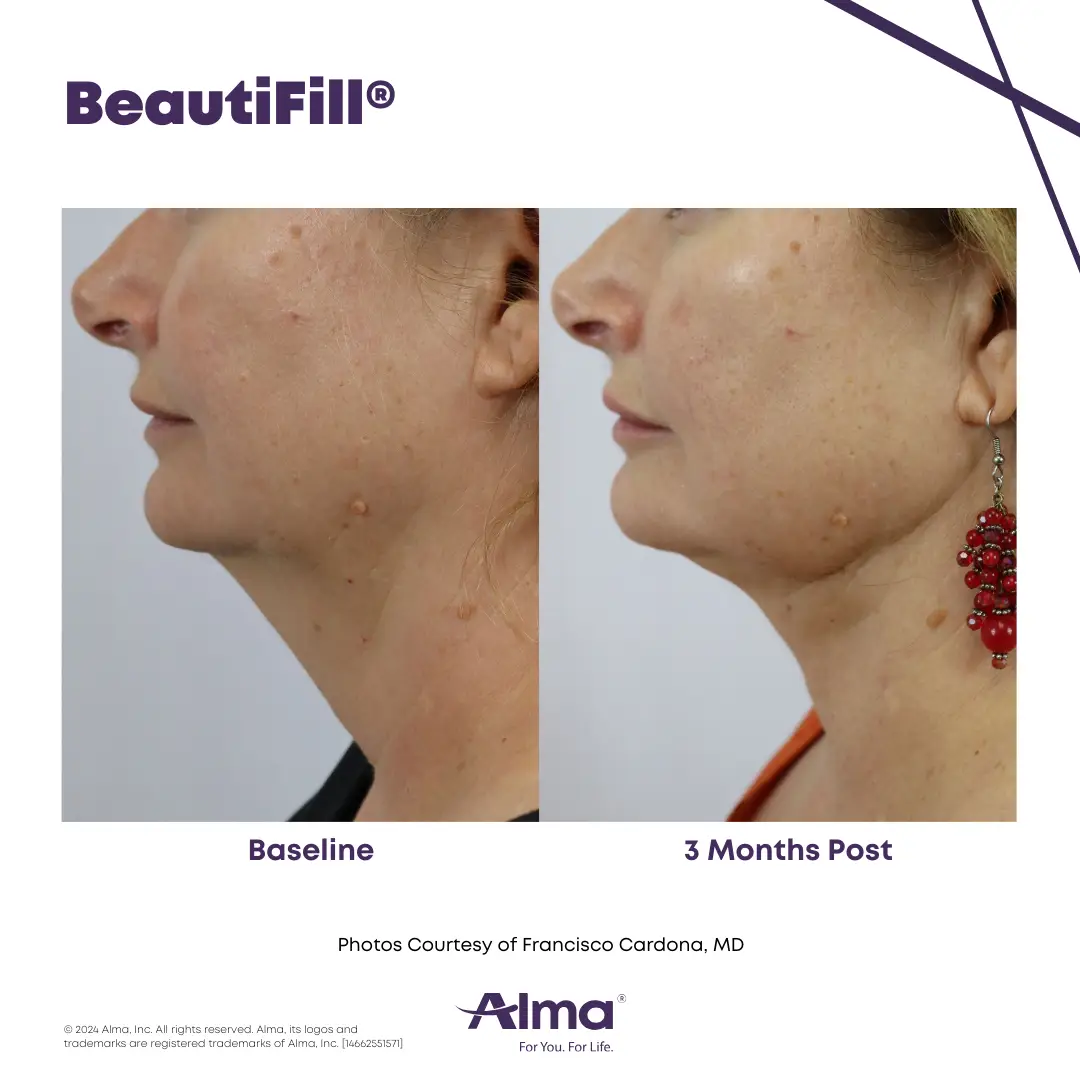 BeautiFill_BA