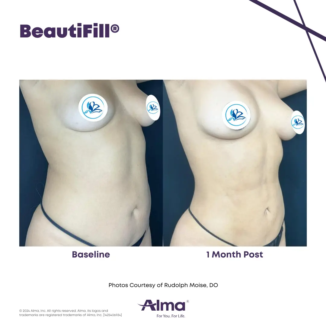 BeautiFill_BA_J